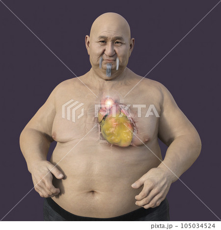 A 3D scientific illustration of an obese man with transparent skin revealing an ascending aortic aneurysm. 105034524
