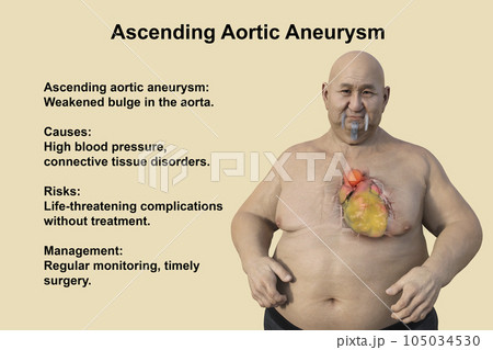 A 3D scientific illustration of an obese man with transparent skin revealing an ascending aortic aneurysm. 105034530