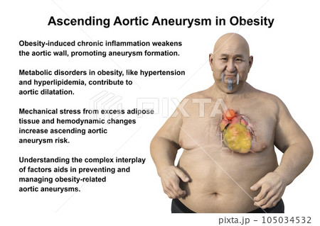 A 3D scientific illustration of an obese man with transparent skin revealing an ascending aortic aneurysm. A 3D scientific illustration of an obese man with transparent skin revealing an ascending aortic aneurysm. 105034532