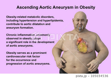 A 3D scientific illustration of an obese man with transparent skin revealing an ascending aortic aneurysm. 105034536
