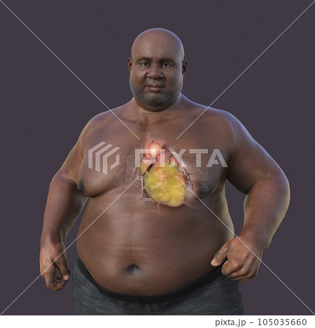 A 3D scientific illustration of an obese man with transparent skin revealing an ascending aortic aneurysm. A 3D scientific illustration of an obese man with transparent skin revealing an ascending aortic aneurysm. 105035660