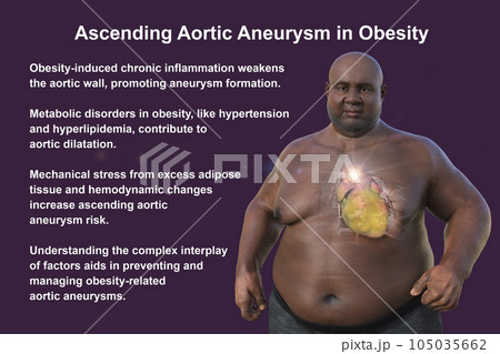 A 3D scientific illustration of an obese man with transparent skin revealing an ascending aortic aneurysm. 105035662