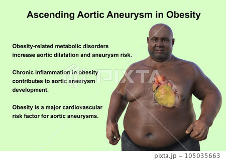 A 3D scientific illustration of an obese man with transparent skin revealing an ascending aortic aneurysm. 105035663