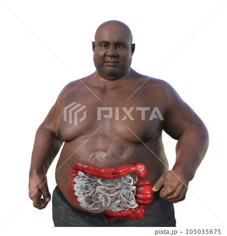 An overweight man with the presence of large intestine spasms associated with irritable bowel syndrome, 3D illustration An overweight man with the presence of large intestine spasms associated with irritable bowel syndrome, 3D illustration 105035675