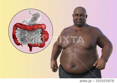 An overweight man with the presence of large intestine spasms associated with irritable bowel syndrome, 3D illustration An overweight man with the presence of large intestine spasms associated with irritable bowel syndrome, 3D illustration 105035676