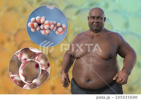 An overweight man with a close-up view of adipocytes and cholesterol molecules, 3D illustration 105035690