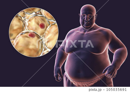 An overweight man with a close-up view of adipocytes, 3D illustration highlighting the role of these fat cells in obesity 105035691