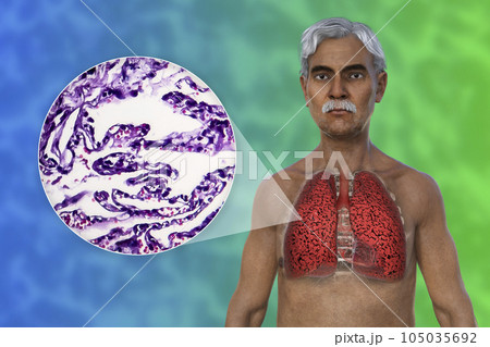 A 3D illustration of the upper half part of a man with transparent skin, revealing the condition of smoker's lungs A 3D illustration of the upper half part of a man with transparent skin, revealing the condition of smoker's lungs 105035692
