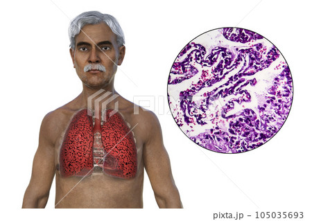 A 3D illustration of the upper half part of a man with transparent skin, revealing the condition of smoker's lungs A 3D illustration of the upper half part of a man with transparent skin, revealing the condition of smoker's lungs 105035693