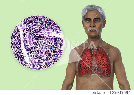 A 3D illustration of the upper half part of a man with transparent skin, revealing the condition of smoker's lungs 105035694