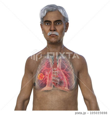 A 3D illustration of the upper half part of a man with transparent skin, revealing a lung mucormycosis lesion A 3D illustration of the upper half part of a man with transparent skin, revealing a lung mucormycosis lesion 105035698