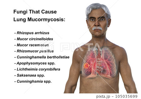 A 3D illustration of the upper half part of a man with transparent skin, revealing a lung mucormycosis lesion A 3D illustration of the upper half part of a man with transparent skin, revealing a lung mucormycosis lesion 105035699