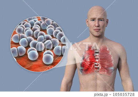 A 3D illustration showcasing the upper half part of a man with transparent skin, revealing the lungs affected by pneumonia A 3D illustration showcasing the upper half part of a man with transparent skin, revealing the lungs affected by pneumonia 105035728