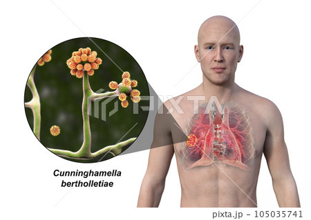 A 3D illustration of the upper half part of a man with transparent skin, revealing a lung mucormycosis lesion, with close-up view of Cunninghamella bertholletiae fungi A 3D illustration of the upper half part of a man with transparent skin, revealing a lung mucormycosis lesion, with close-up view of Cunninghamella bertholletiae fungi 105035741