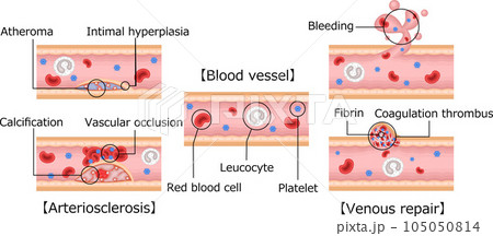 血管　動脈硬化　血管修復　イラスト　英語 105050814