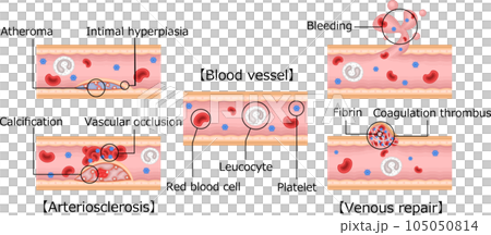 血管　動脈硬化　血管修復　イラスト　英語 105050814