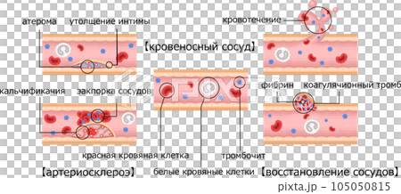 血管　動脈硬化　血管修復　イラスト　ロシア語 105050815