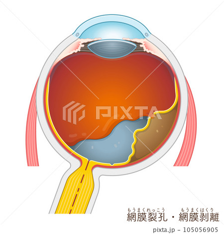 眼球・網膜裂孔・網膜剥離・retinal tear・retinal detachment・イラスト 眼球・網膜裂孔・網膜剥離・retinal tear・retinal detachment・イラスト 105056905
