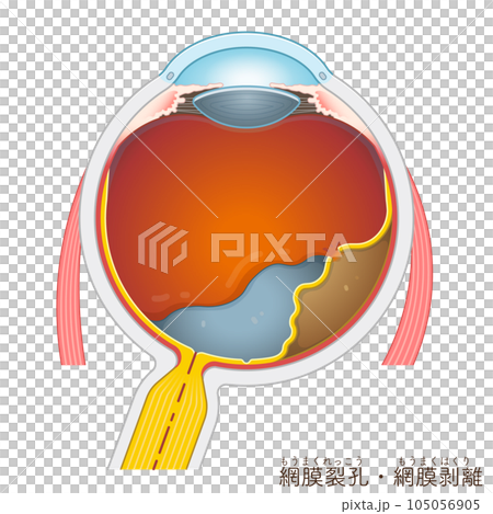 眼球・網膜裂孔・網膜剥離・retinal tear・retinal detachment・イラスト 眼球・網膜裂孔・網膜剥離・retinal tear・retinal detachment・イラスト 105056905