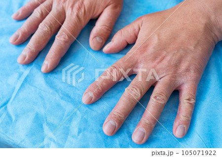 Psoriasis on the hands of a man. Dry male hand on a blue background. Hike to the doctor, treatment of eczema and psoriasis. 105071922