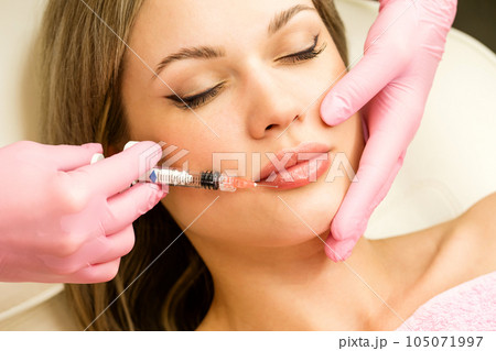 Lip augmentation procedure Lip augmentation procedure 105071997