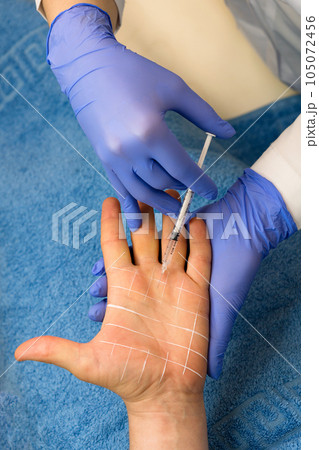 Treatment hyperhidrosis botulinum toxin 105072456