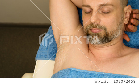 Treatment hyperhidrosis botulinum toxin 105072458
