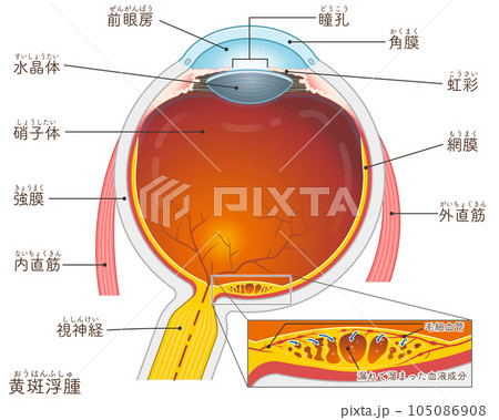 眼球・黄斑浮腫・macular edema・イラスト・eye・illustration 105086908