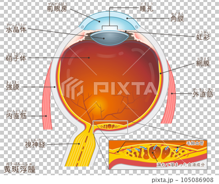 眼球・黄斑浮腫・macular edema・イラスト・eye・illustration 105086908