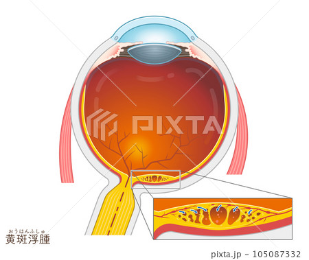 眼球・黄斑浮腫・macular edema・イラスト・eye・illustration 105087332