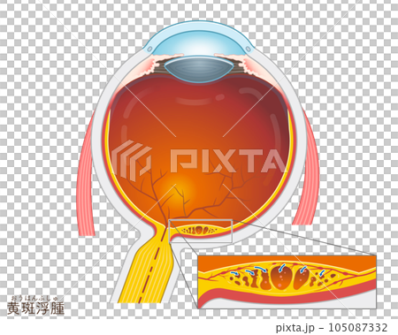 Eyeball, macular edema, macular edema, illustration, eye, illustration 105087332