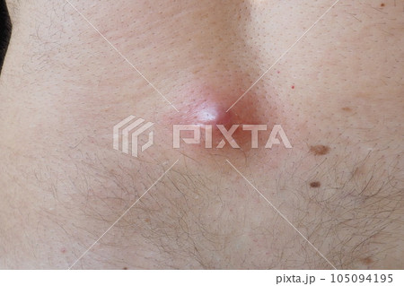 Abscess furuncle carbuncle on male hairy back. Clogged pore leading to skin inflammation. Surgical solution of cosmetic problems. Redness, swelling and pimple formation. Dermatology and surgery Abscess furuncle carbuncle on male hairy back. Clogged pore leading to skin inflammation. Surgical solution of cosmetic problems. Redness, swelling and pimple formation. Dermatology and surgery 105094195
