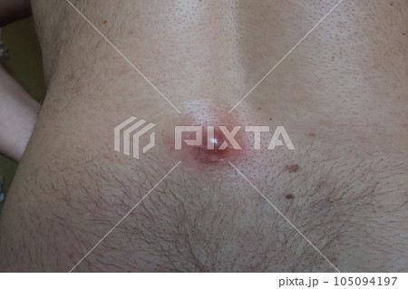 Abscess furuncle carbuncle on male hairy back. Clogged pore leading to skin inflammation. Surgical solution of cosmetic problems. Redness, swelling and pimple formation. Dermatology and surgery Abscess furuncle carbuncle on male hairy back. Clogged pore leading to skin inflammation. Surgical solution of cosmetic problems. Redness, swelling and pimple formation. Dermatology and surgery 105094197