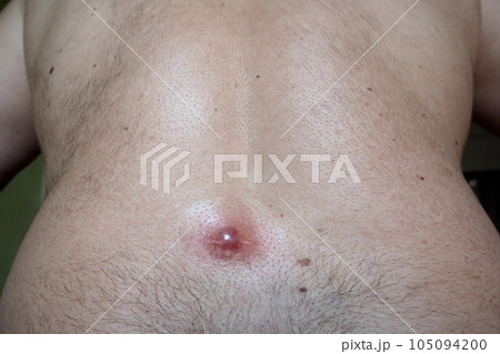 Abscess furuncle carbuncle on male hairy back. Clogged pore leading to skin inflammation. Surgical solution of cosmetic problems. Redness, swelling and pimple formation. Dermatology and surgery Abscess furuncle carbuncle on male hairy back. Clogged pore leading to skin inflammation. Surgical solution of cosmetic problems. Redness, swelling and pimple formation. Dermatology and surgery 105094200