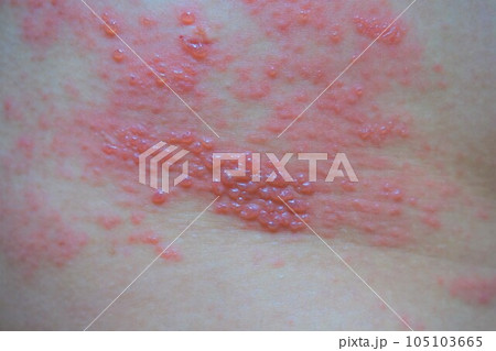 帯状疱疹 たいじょうほうしん 腰臀部 男性 帯状疱疹 たいじょうほうしん 腰臀部 男性 105103665