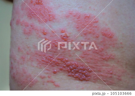 帯状疱疹 たいじょうほうしん 腰臀部 男性 帯状疱疹 たいじょうほうしん 腰臀部 男性 105103666