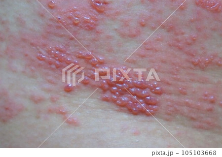 帯状疱疹　たいじょうほうしん　腰臀部　男性　 105103668