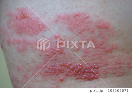 帯状疱疹 たいじょうほうしん 腰臀部 男性 帯状疱疹 たいじょうほうしん 腰臀部 男性 105103671