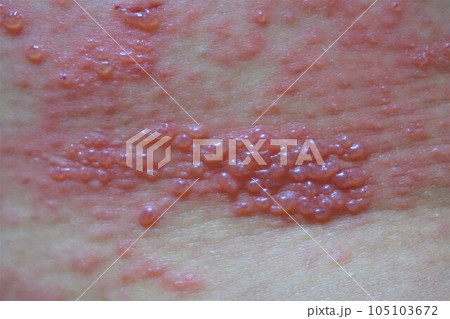 帯状疱疹 たいじょうほうしん 腰臀部 男性 帯状疱疹 たいじょうほうしん 腰臀部 男性 105103672
