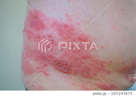 帯状疱疹 たいじょうほうしん 腰臀部 男性 帯状疱疹 たいじょうほうしん 腰臀部 男性 105103675