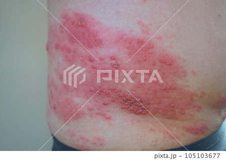帯状疱疹 たいじょうほうしん 腰臀部 男性 帯状疱疹 たいじょうほうしん 腰臀部 男性 105103677