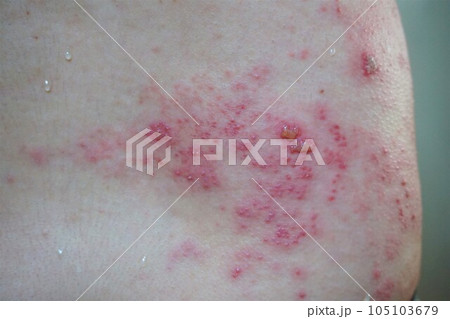 帯状疱疹 たいじょうほうしん 腰臀部 男性 帯状疱疹 たいじょうほうしん 腰臀部 男性 105103679