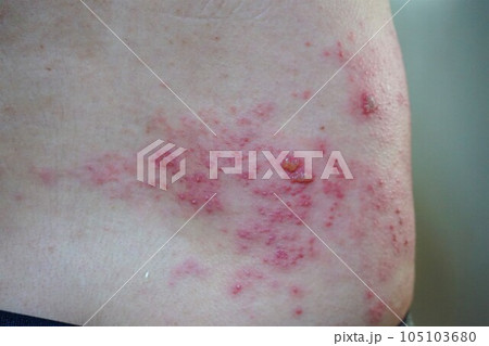帯状疱疹 たいじょうほうしん 腰臀部 男性 帯状疱疹 たいじょうほうしん 腰臀部 男性 105103680