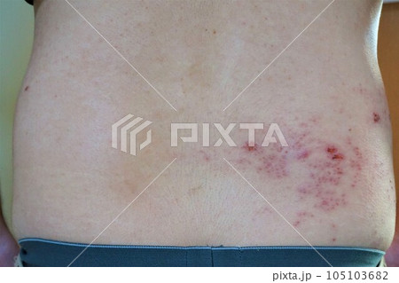帯状疱疹　たいじょうほうしん　腰臀部　男性　 105103682