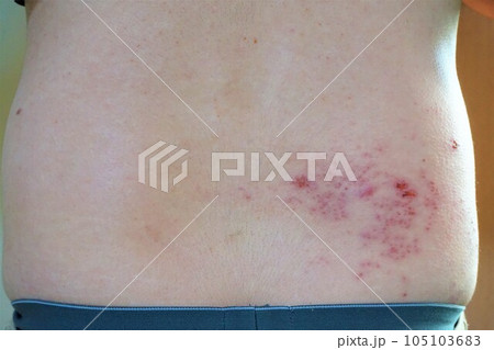 帯状疱疹 たいじょうほうしん 腰臀部 男性 帯状疱疹 たいじょうほうしん 腰臀部 男性 105103683