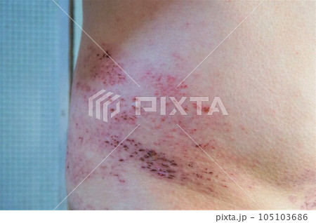 帯状疱疹 たいじょうほうしん 腰臀部 男性 帯状疱疹 たいじょうほうしん 腰臀部 男性 105103686