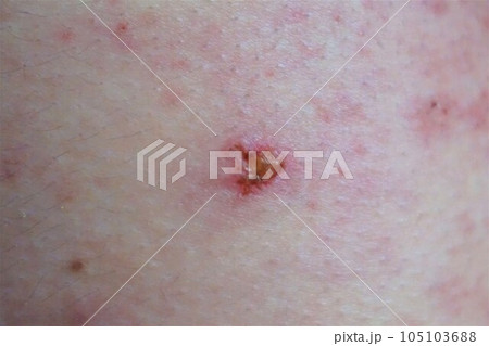 帯状疱疹　たいじょうほうしん　腰臀部　男性　 105103688