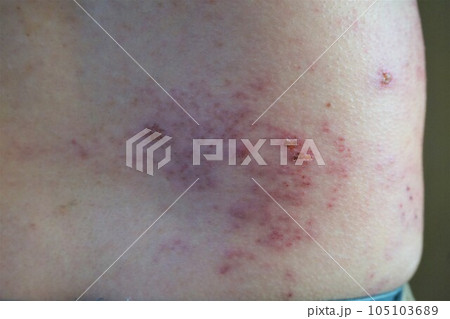 帯状疱疹 たいじょうほうしん 腰臀部 男性 帯状疱疹 たいじょうほうしん 腰臀部 男性 105103689