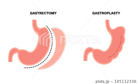Gastrectomy and gastroplasty Gastrectomy and gastroplasty 105112336