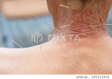 doctor sticks needles into the human body on the acupuncture. Traditional Chinese Medicine. acupuncture treatment doctor sticks needles into the human body on the acupuncture. Traditional Chinese Medicine. acupuncture treatment 105121829